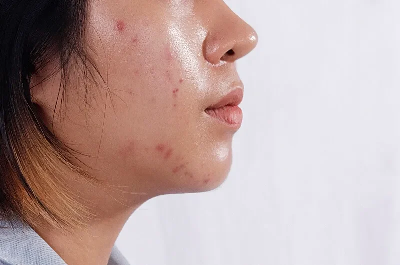 Mỹ Phẩm Chăm Sóc Da Cho Da Dầu Mụn