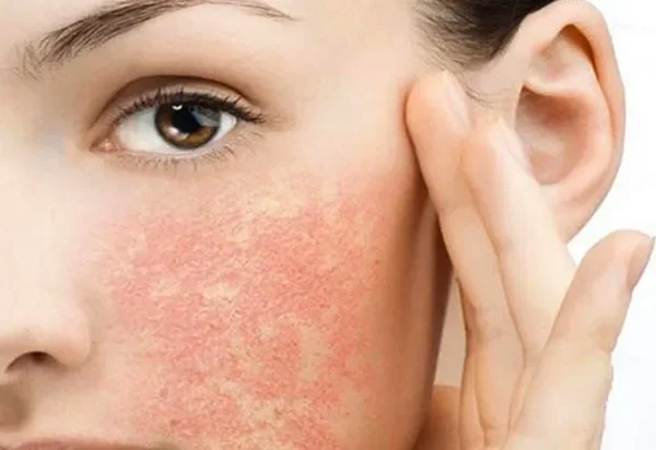 "Tránh Xa" Các Thành Phần Có Khả Năng Gây Kích Ứng