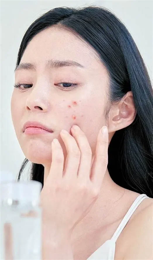 "Nhận Diện" Làn Da Dầu Mụn: Hiểu Rõ Để Chăm Sóc Đúng Cách