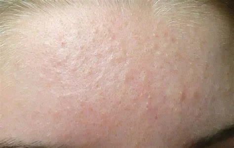 Cách Trị Mụn Ẩn Hiệu Quả Với Mỹ Phẩm Chăm Sóc Da