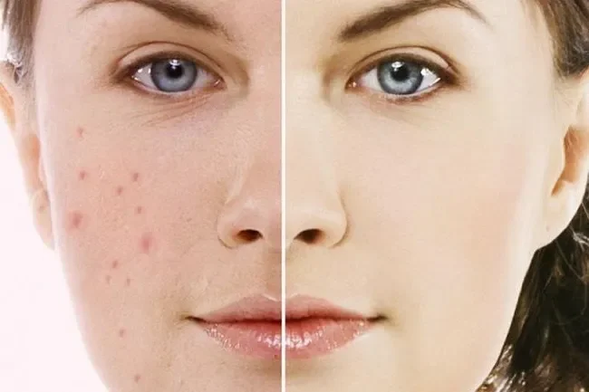 Cách Phục Hồi Da Sau Khi Điều Trị Mụn Với Mỹ Phẩm Phù Hợp